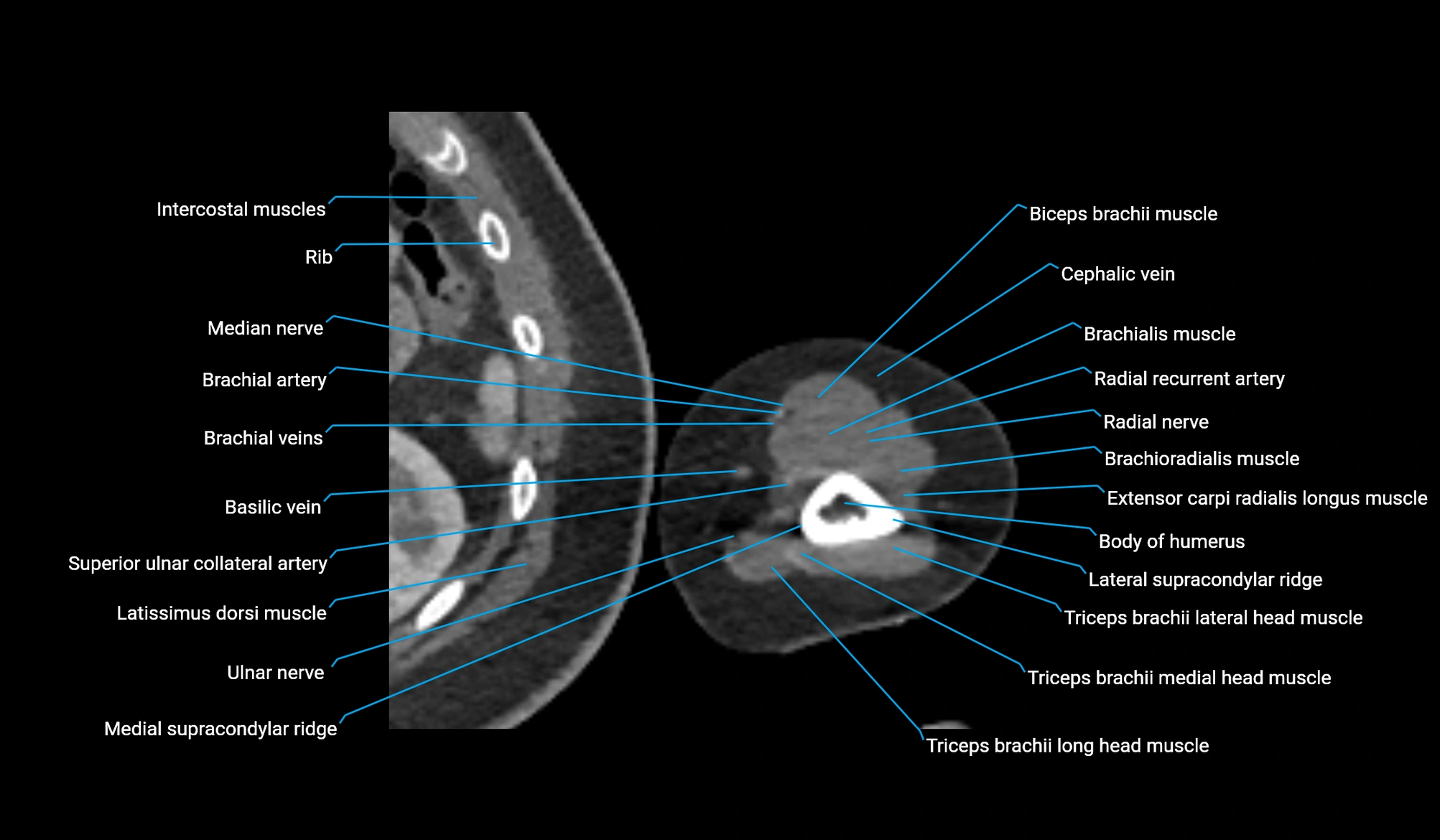 CT upper arm axial  cross sectional anatomy labelled radiology image -00342.webp